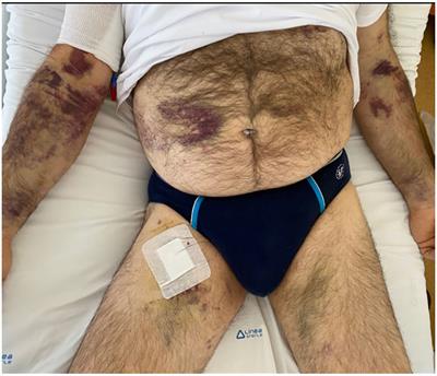 Hemophagocytic lymphohistiocytosis in gastric cancer: A rare syndrome for the oncologist. Case report and brief review